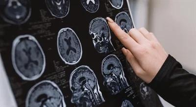 Odrzucony lek na Alzheimera. "Ryzyko krwawienia i obrzęku w mózgu"